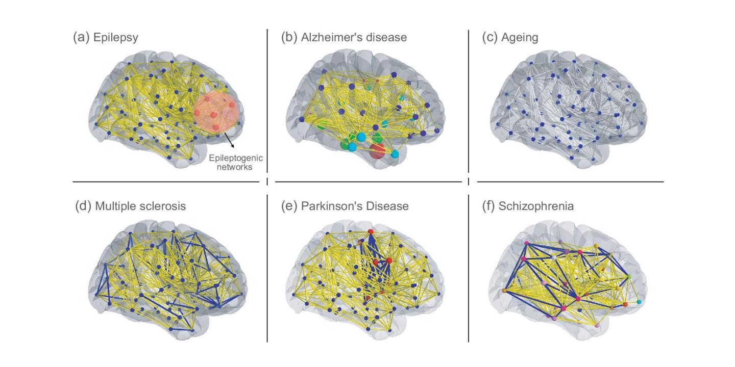 Advancing Neuroscience With Personalised Brain Models