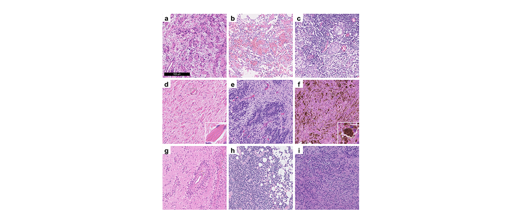 Brain tumor data now available on EBRAINS