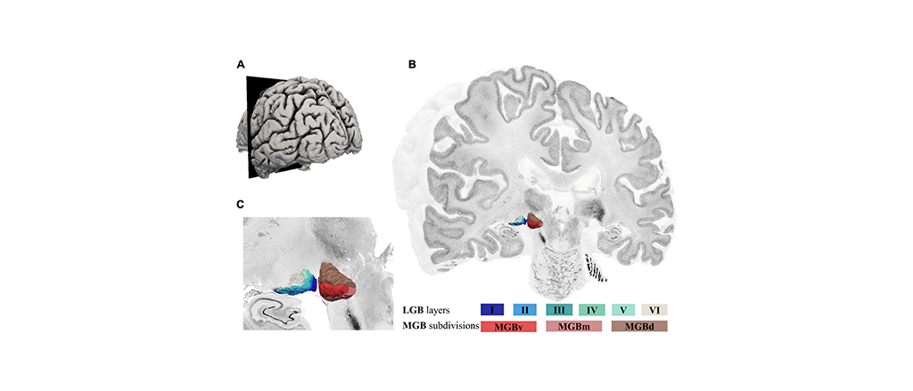 EBRAINS provides access to new high-resolution cytoarchitectonic 3D map of the metathalamus
