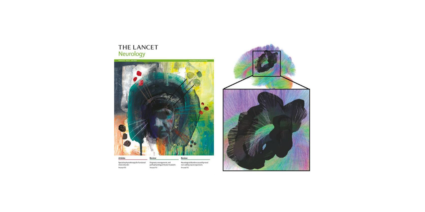 Lancet Neurology
