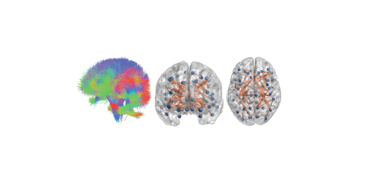 Personalised Brain Models Improve Clinical Prediction In Multiple Sclerosis
