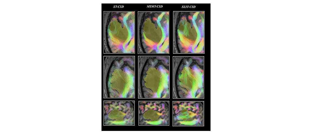Pre- and post-surgery brain tumor data available on EBRAINS