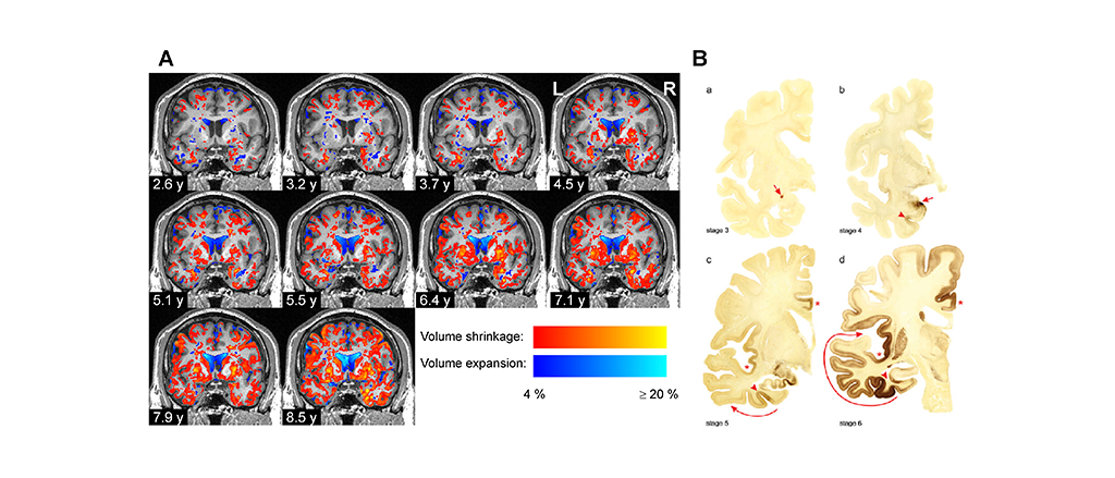 Scientists detect volume losses in brain regions associated with Parkinson's using EBRAINS