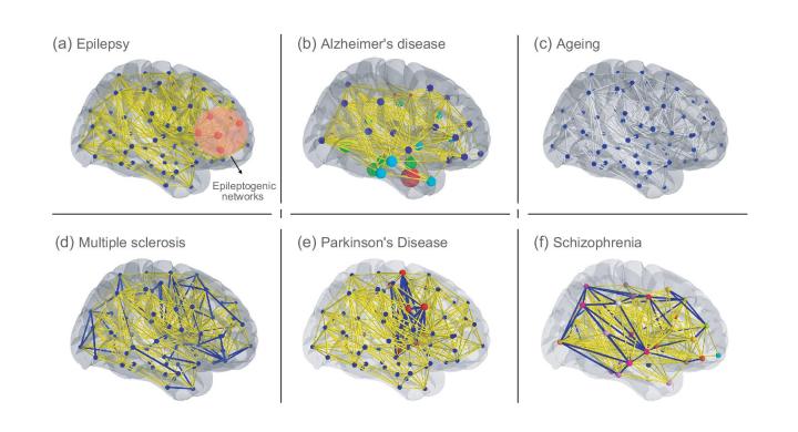 Advancing Neuroscience With Personalised Brain Models