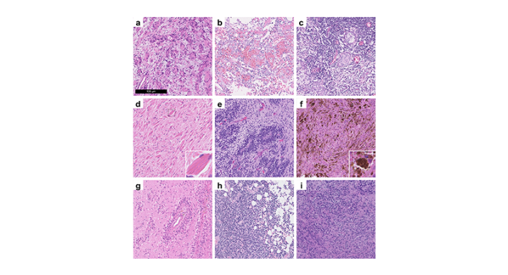 Brain tumor data now available on EBRAINS