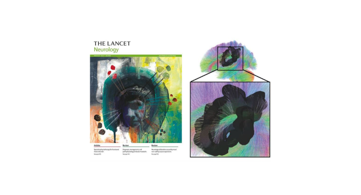 Lancet Neurology