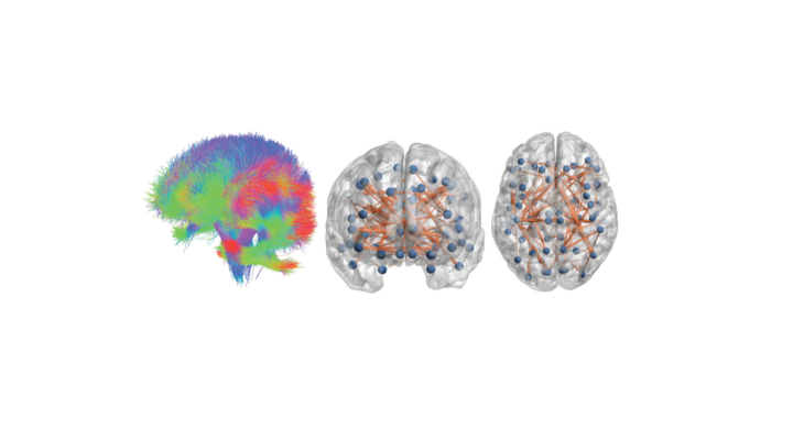 Personalised Brain Models Improve Clinical Prediction In Multiple Sclerosis