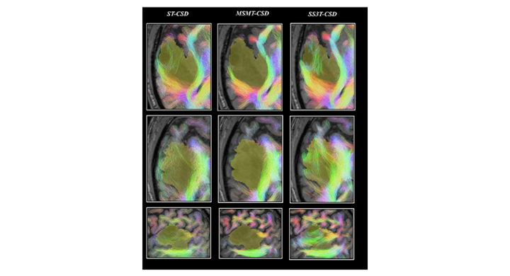Pre- and post-surgery brain tumor data available on EBRAINS