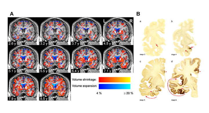 Scientists detect volume losses in brain regions associated with Parkinson's using EBRAINS