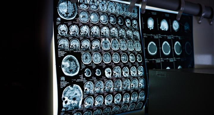 Image of brain scans