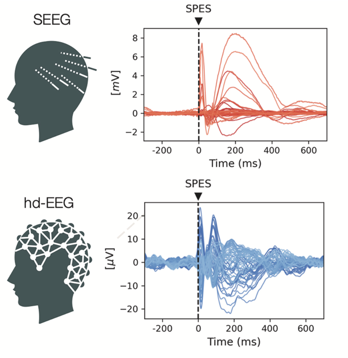 Responses to single-pulse electrical stimulation (SPES) in one study participant, recorded via SEEG) hdEEG. Brain stimulation is used in therapy and research and applies electrical or magnetic fields to modulate neural activity. Image: Rabuffo G. et al. Brain Stimulation, 2026.