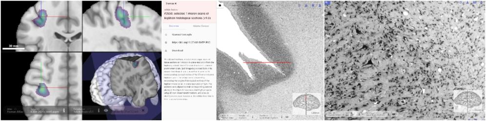 Three image sequence showing brain mapping technique