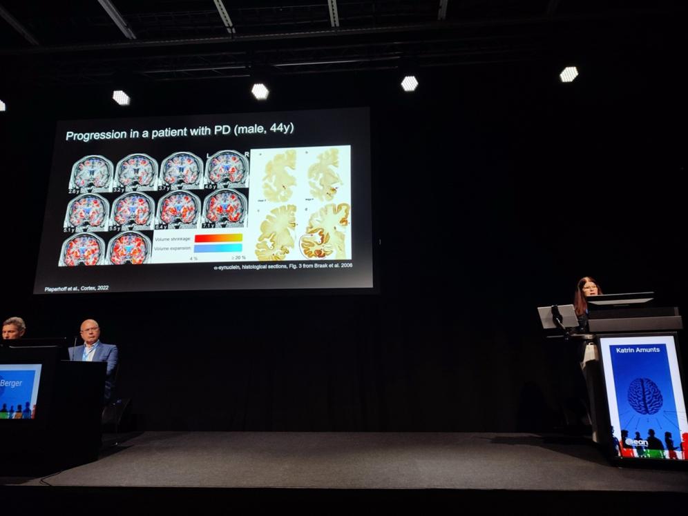 Prof. Amunts demonstrated research results conducted on patients affected by Parkinson's disease